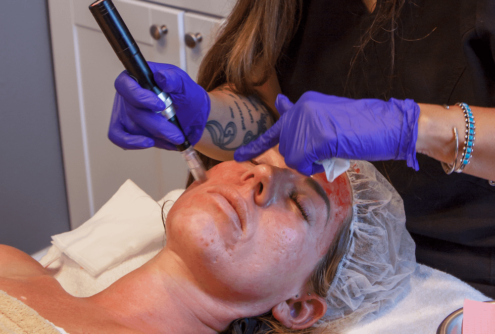 RejuviTox Microneedling: Achieve Radiant, Youthful Skin